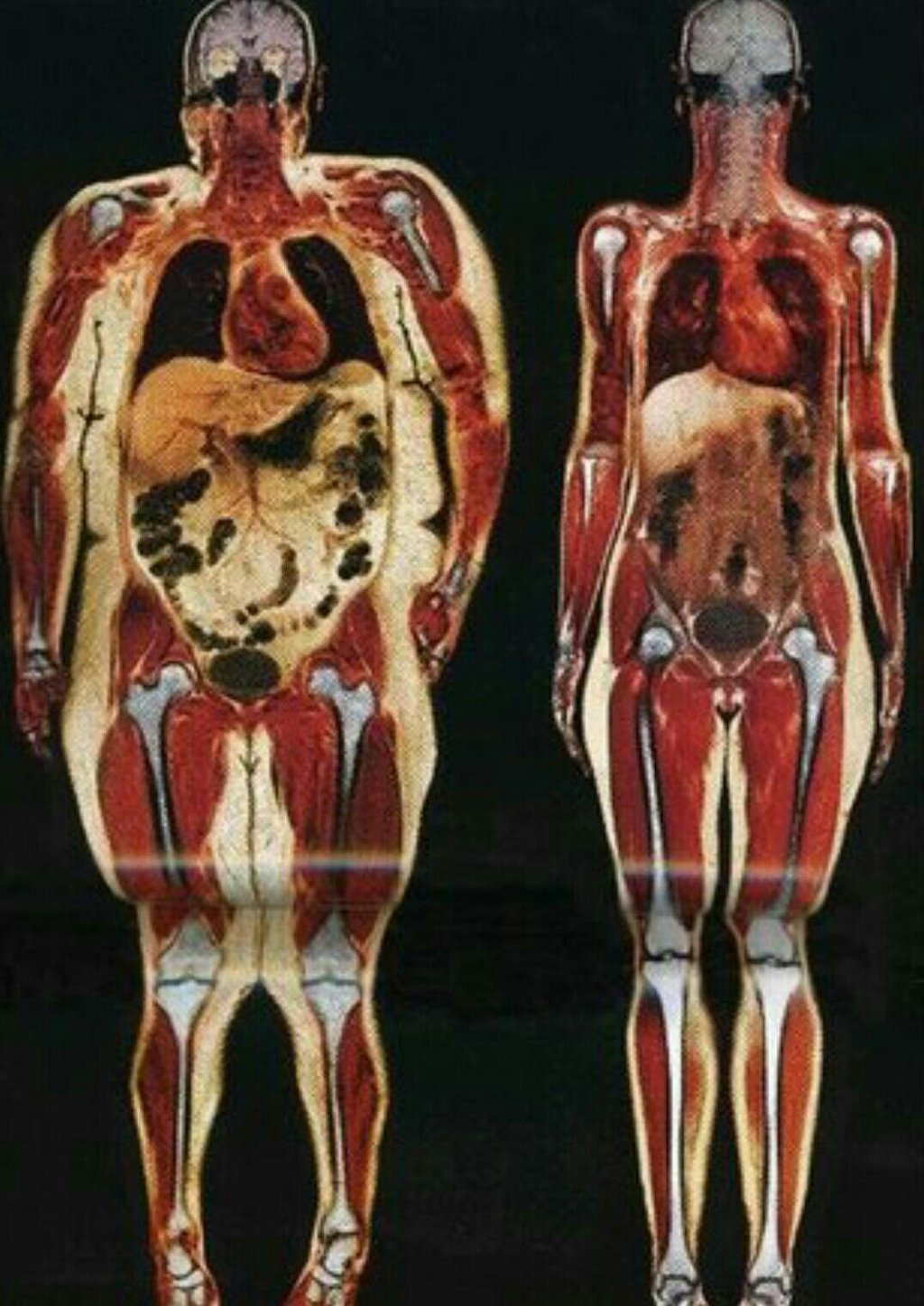 Толстый человек анатомия